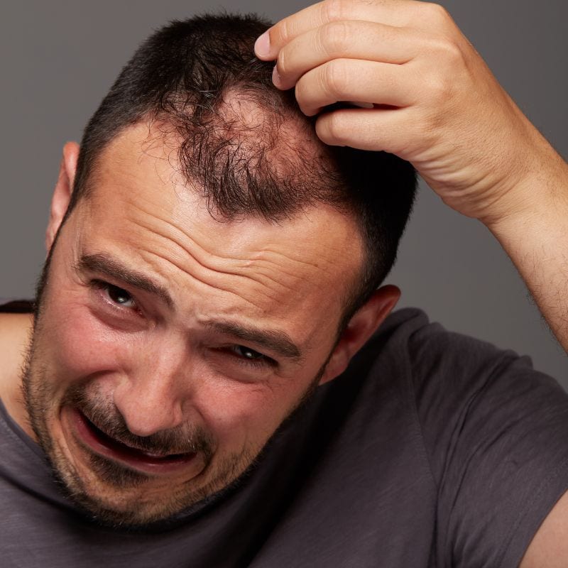 alopecija areata
