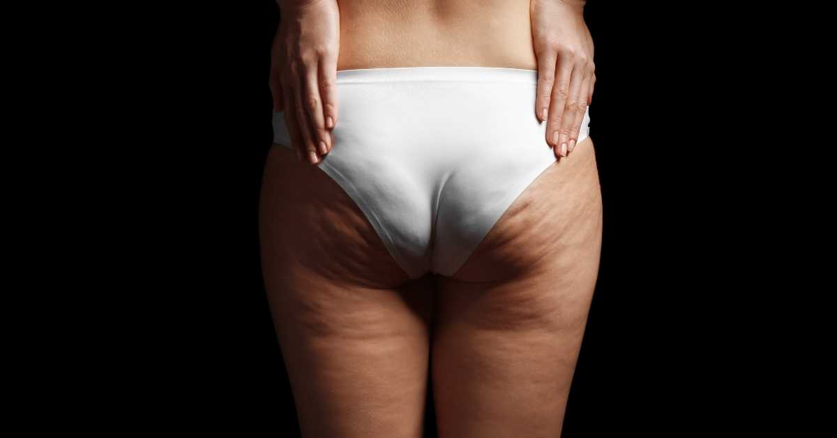 fibrozni celulit