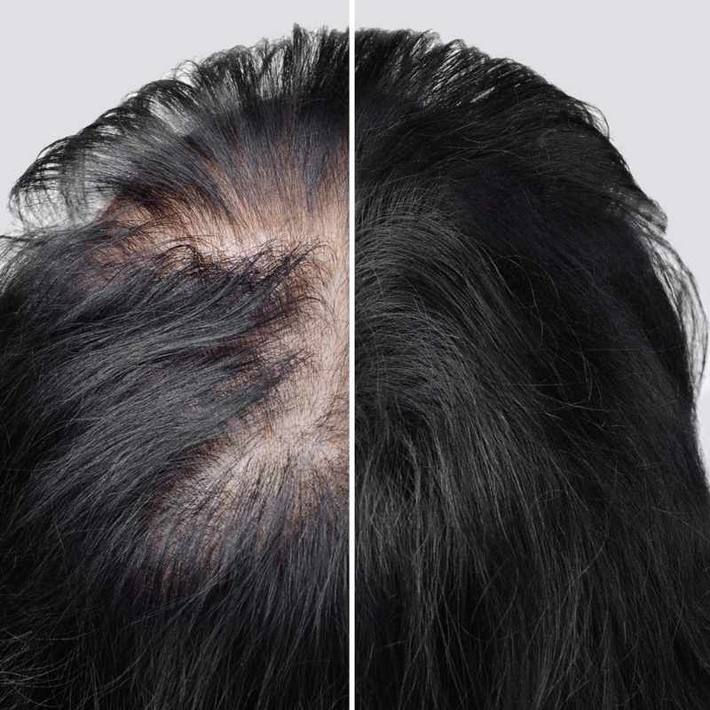 šta je alopecija
