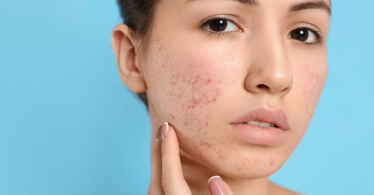 acne vulgaris