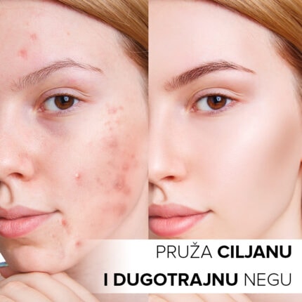 aknolin gel ciljana i dugotrajna nega