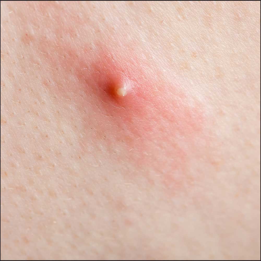 pustule simptomi