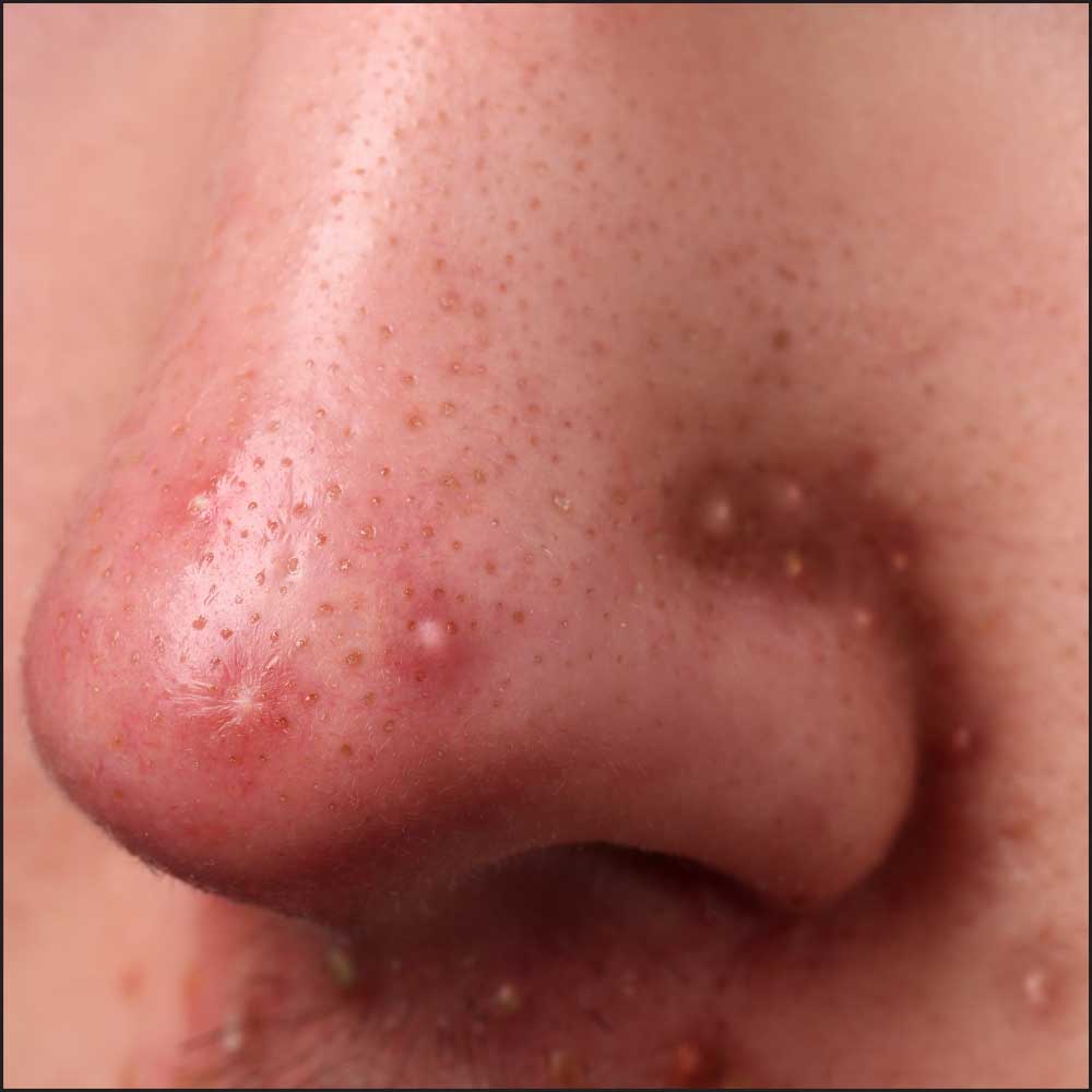 pustule na licu