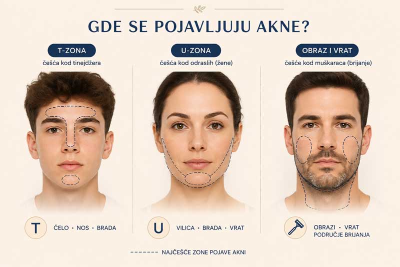 mesto izbijanja akni kod odraslih mesto izbijanja akni kod odraslih