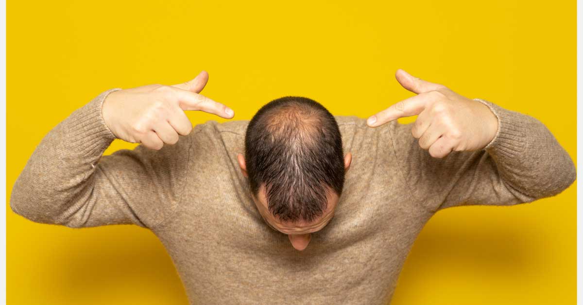 androgena alopecija