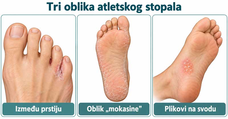 atletsko stopalo simptomi