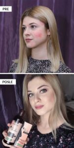 iskustvo aknolin