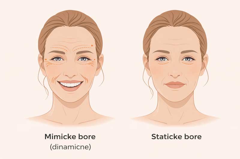mimičke vs statične bore mimičke vs statične bore