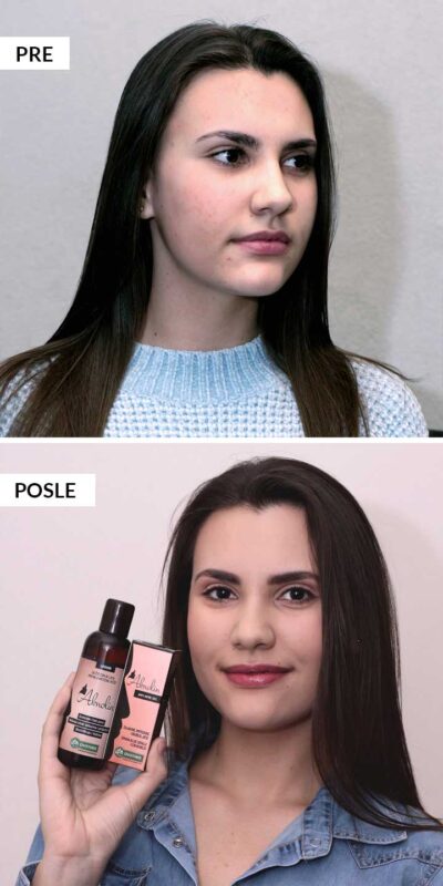 nevena-iskustvo-aknolin nevena iskustvo aknolin