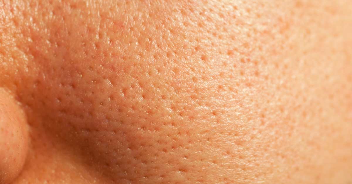 prosirene pore