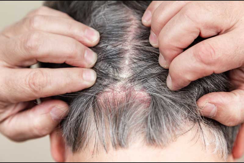 psorijaza kože glave psorijaza kože glave