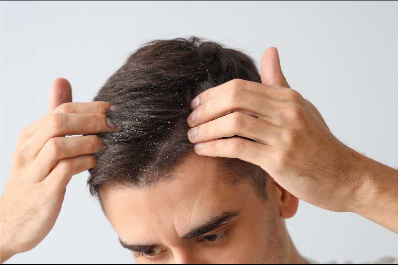šampon za seboreični dermatitis šampon za seboreični dermatitis