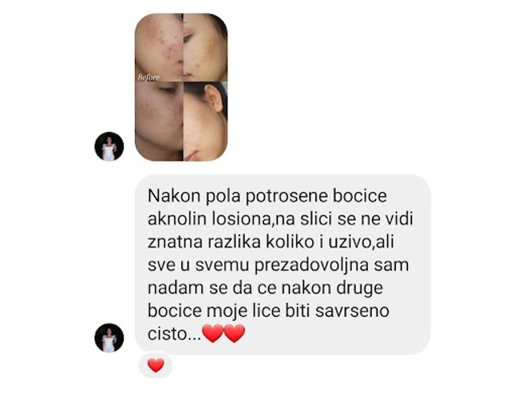 aknolin iskustvo