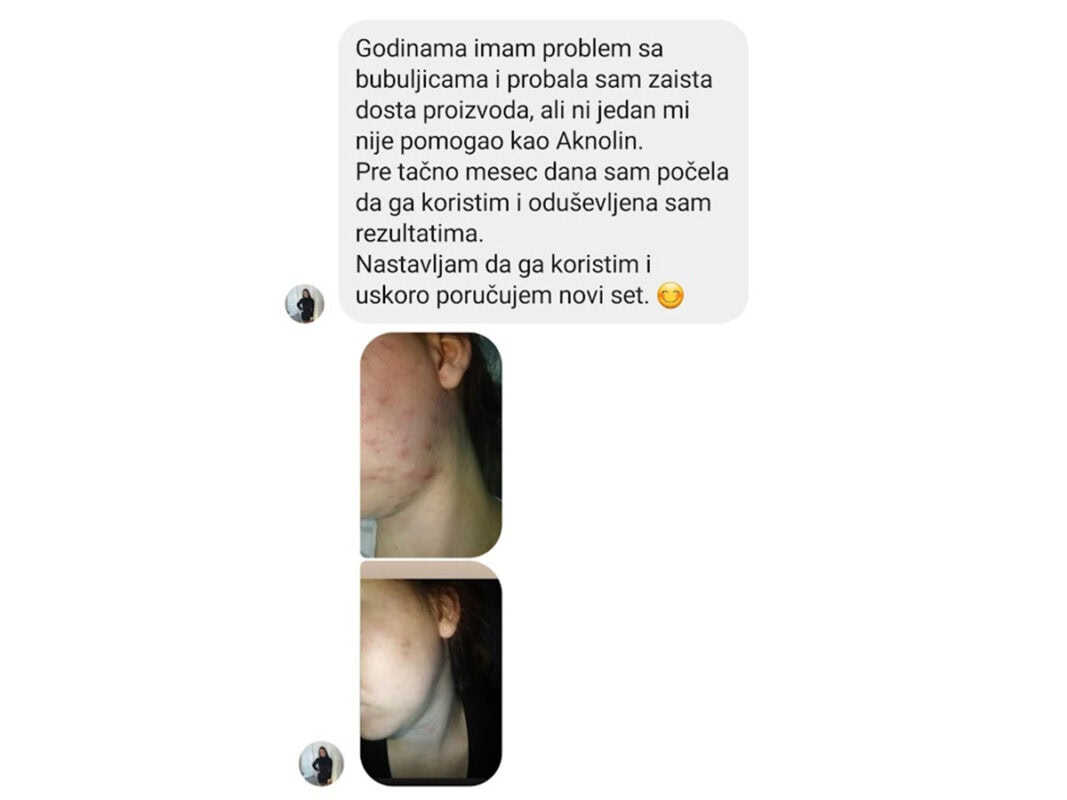 slika 3 aknolin iskustvo